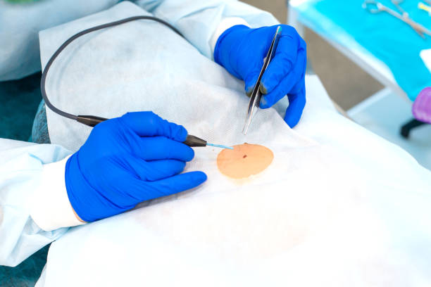 Electrocautery